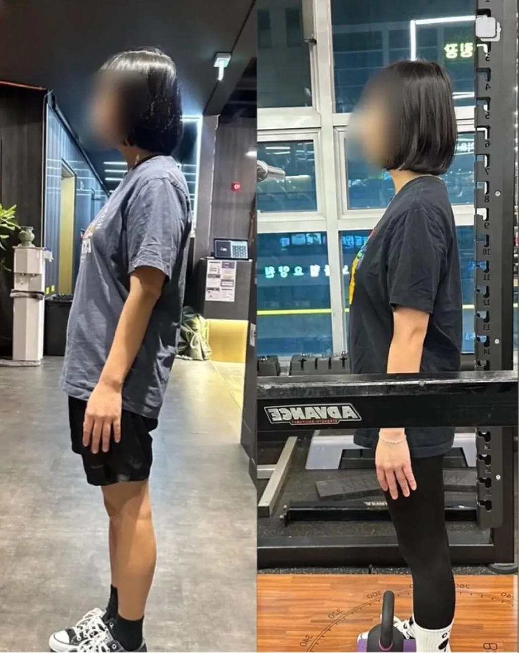회원 옆모습 전후 비교